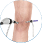 arthroscopic knee surgery by Dr. McCarthy