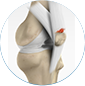 knee tendon repair by Dr. McCarthy